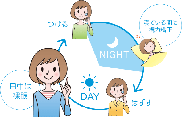 オルソケラトロジーの仕組み:夜つける→寝ている間に視力矯正→朝はずす→日中は裸眼